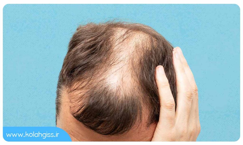 انواع مختلف ریزش مو آلوپسی آره آتا